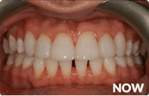 Severe Phobia of Dentists now